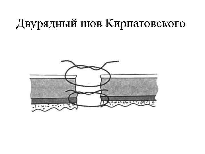 Двурядный шов Кирпатовского 