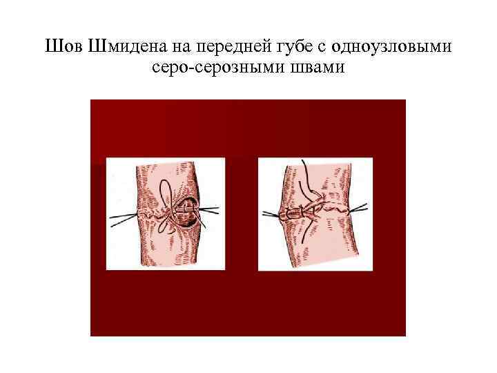 Шов Шмидена на передней губе с одноузловыми серо-серозными швами 