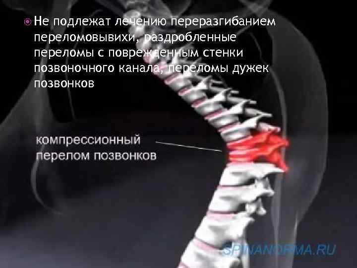  Не подлежат лечению переразгибанием переломовывихи, раздробленные переломы с поврежденным стенки позвоночного канала, переломы