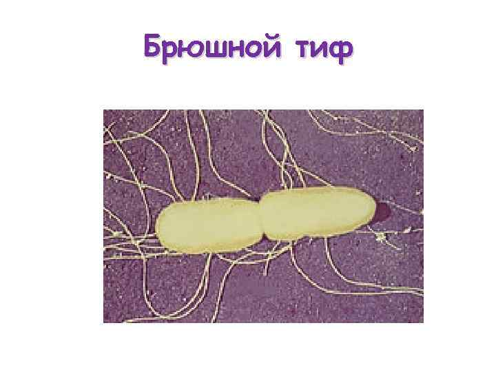 Брюшной тиф 