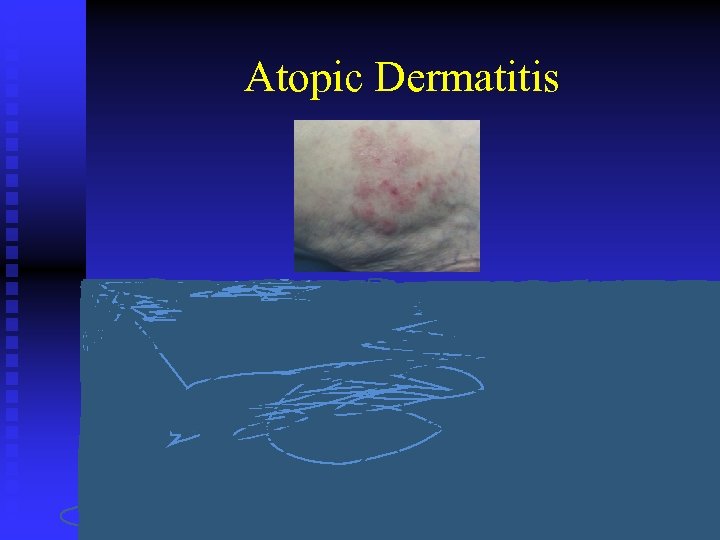 Atopic Dermatitis Adam Goldstein, MD Associate Professor UNC Department of Family Medicine Chapel Hill,