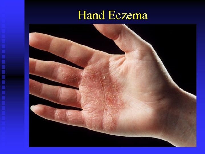 Hand Eczema 