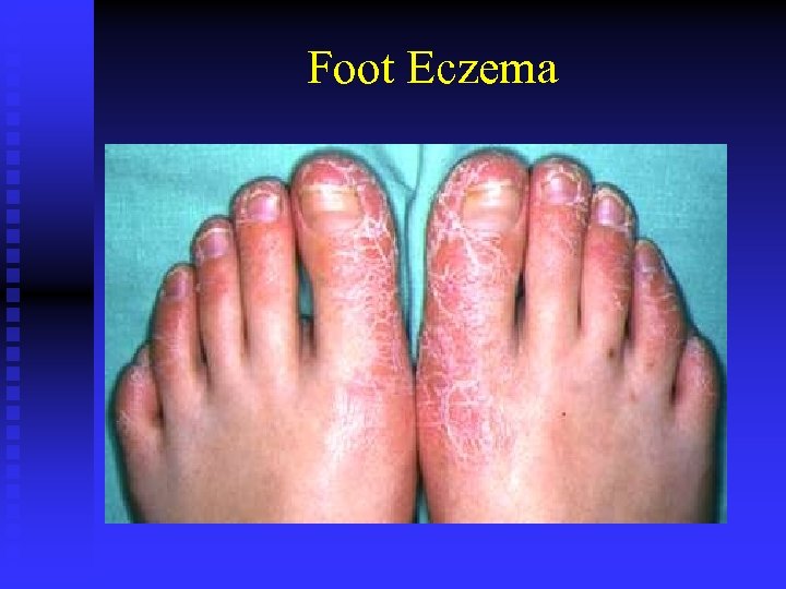 Foot Eczema 