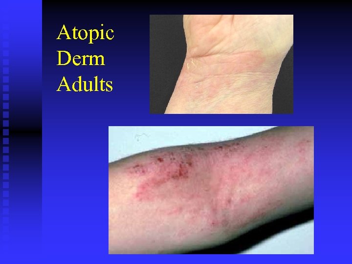 Atopic Derm Adults 