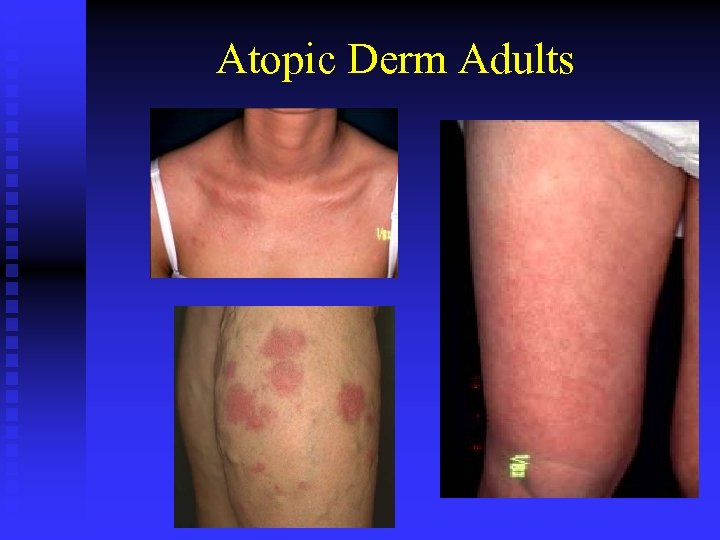 Atopic Derm Adults 