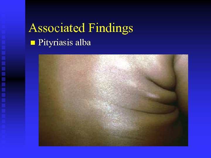 Associated Findings n Pityriasis alba 