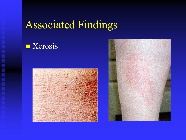 Associated Findings n Xerosis 