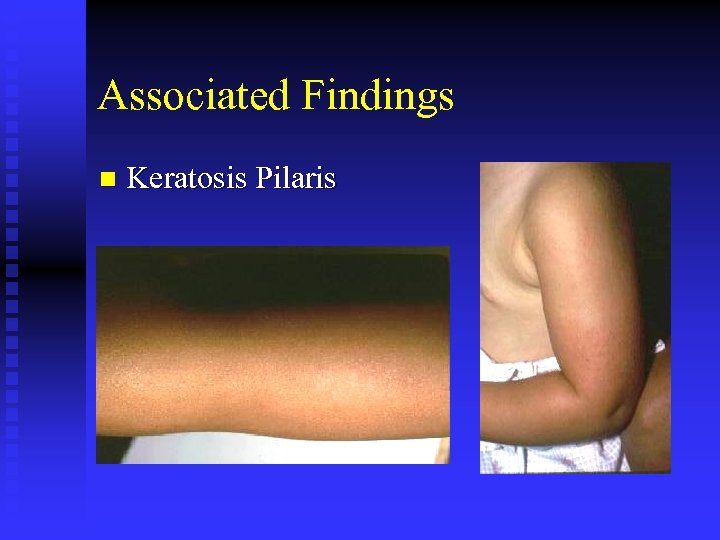 Associated Findings n Keratosis Pilaris 