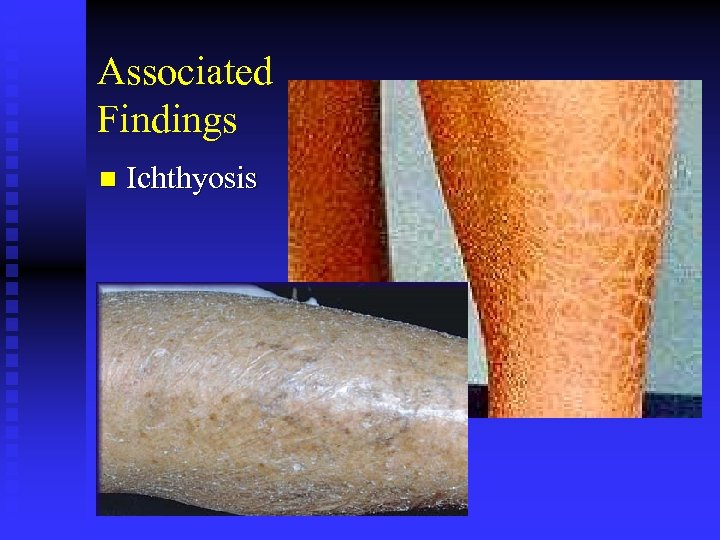 Associated Findings n Ichthyosis 