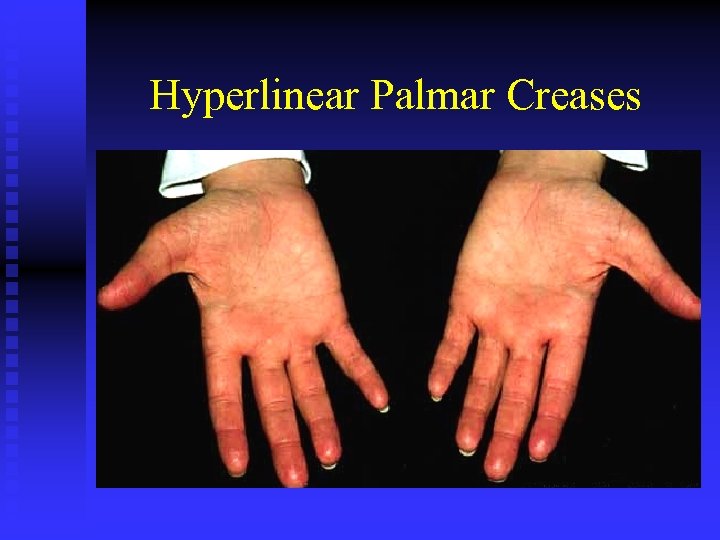 Hyperlinear Palmar Creases 