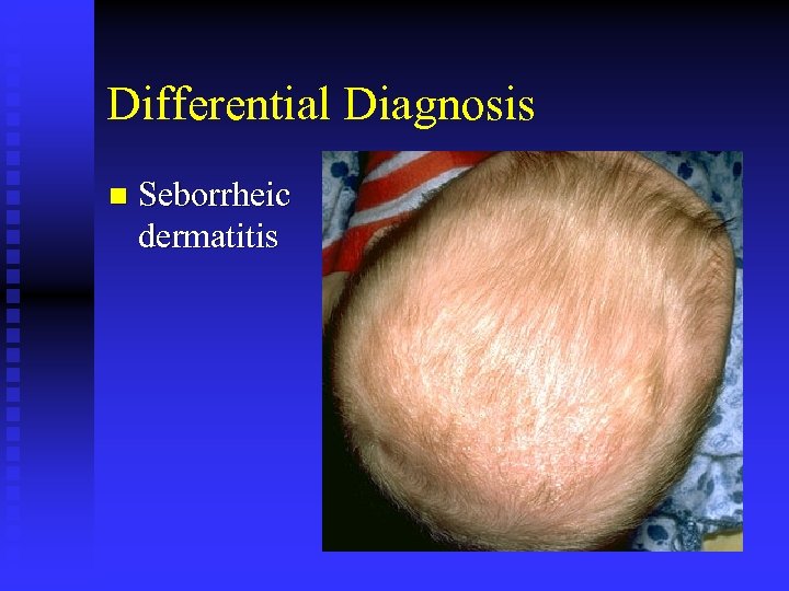 Differential Diagnosis n Seborrheic dermatitis 