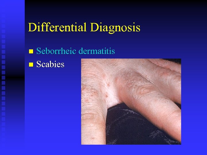 Differential Diagnosis Seborrheic dermatitis n Scabies n 