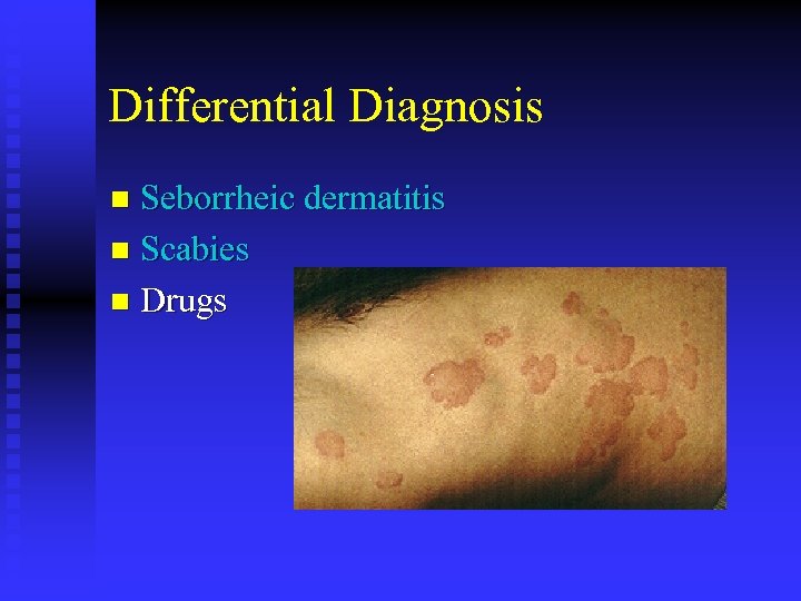 Differential Diagnosis Seborrheic dermatitis n Scabies n Drugs n 