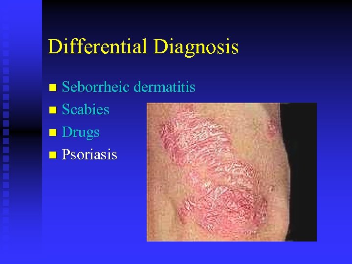 Differential Diagnosis Seborrheic dermatitis n Scabies n Drugs n Psoriasis n 