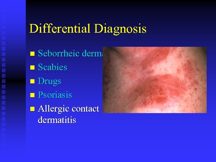 Differential Diagnosis Seborrheic dermatitis n Scabies n Drugs n Psoriasis n Allergic contact dermatitis