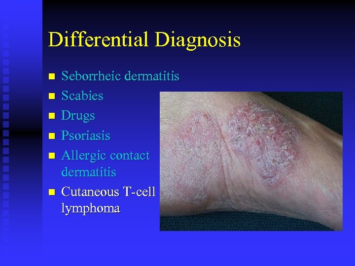 Differential Diagnosis n n n Seborrheic dermatitis Scabies Drugs Psoriasis Allergic contact dermatitis Cutaneous