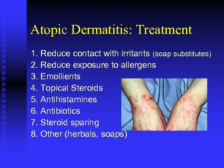 Atopic Dermatitis: Treatment 1. Reduce contact with irritants (soap substitutes) 2. Reduce exposure to