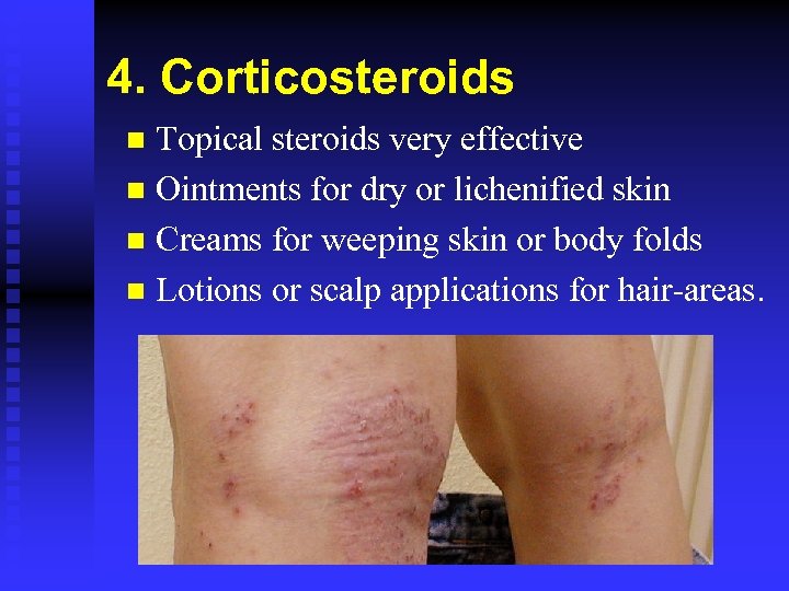 4. Corticosteroids Topical steroids very effective n Ointments for dry or lichenified skin n