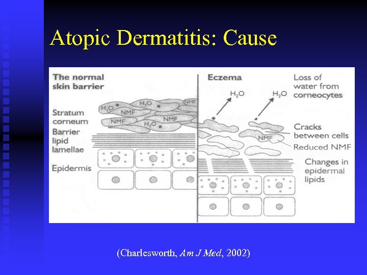 Atopic Dermatitis: Cause (Charlesworth, Am J Med, 2002) 