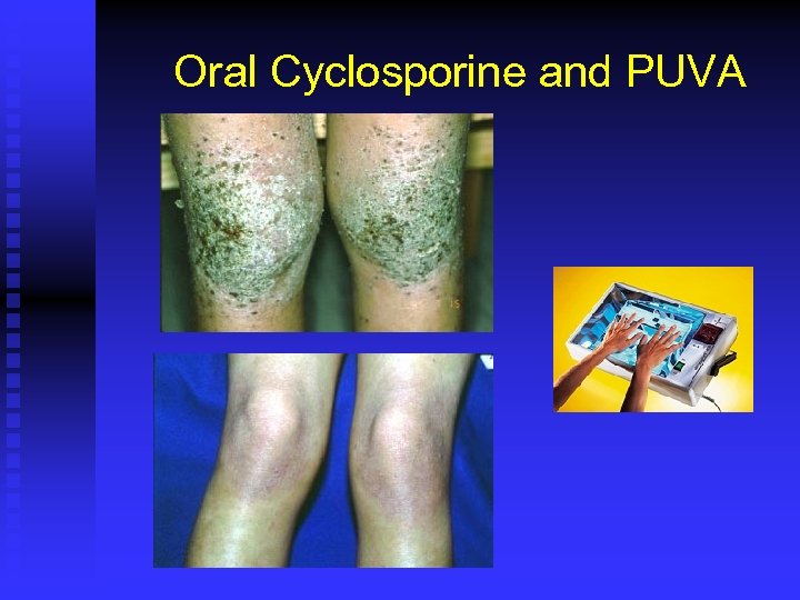 Oral Cyclosporine and PUVA 