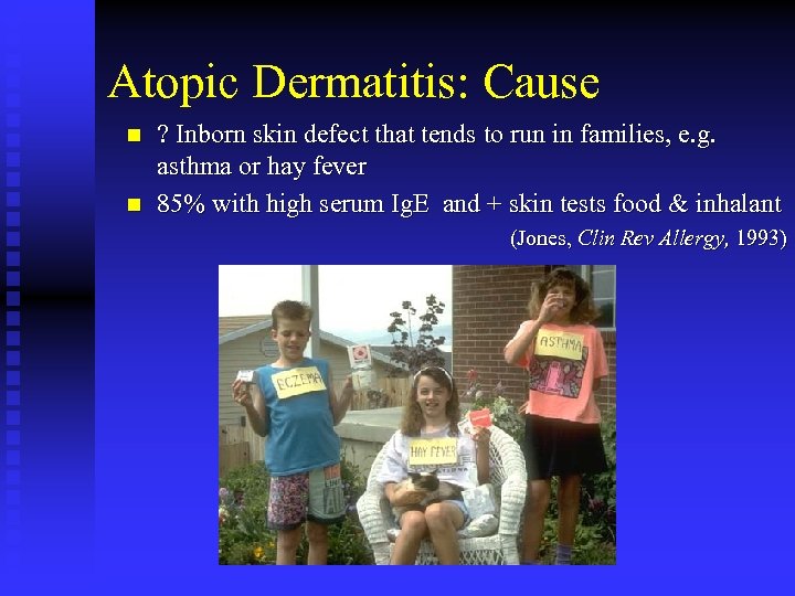 Atopic Dermatitis: Cause n n ? Inborn skin defect that tends to run in