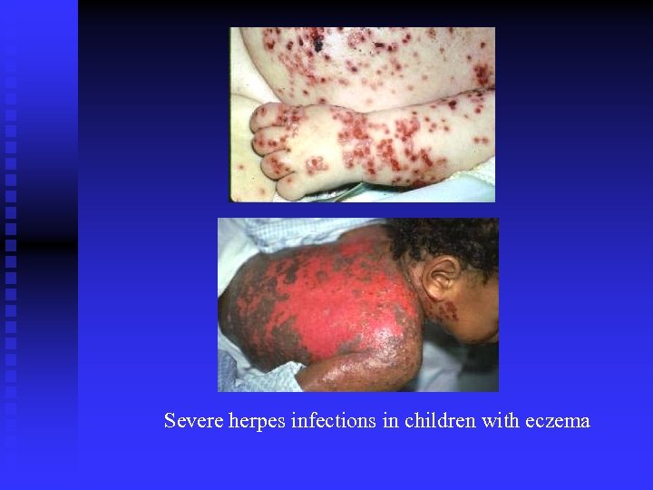 Severe herpes infections in children with eczema 