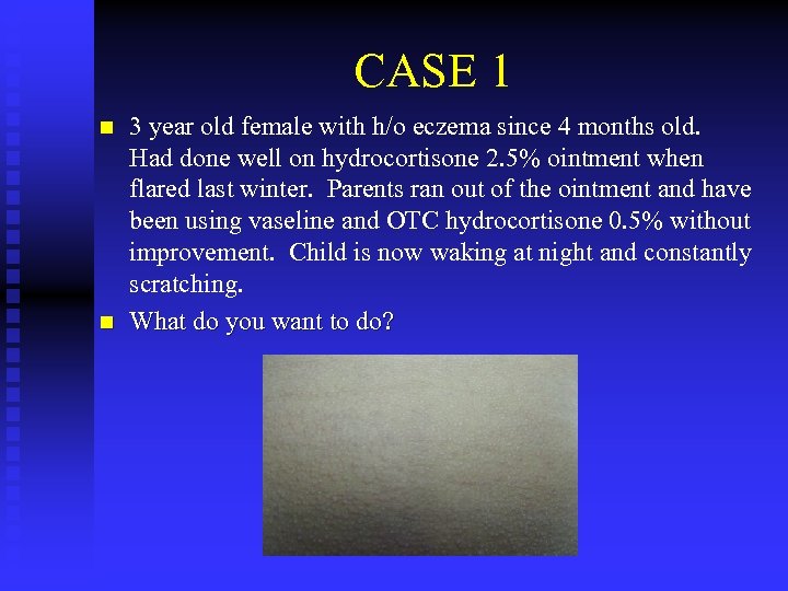 CASE 1 n n 3 year old female with h/o eczema since 4 months