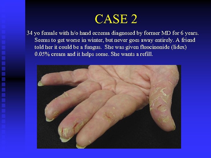 CASE 2 34 yo female with h/o hand eczema diagnosed by former MD for