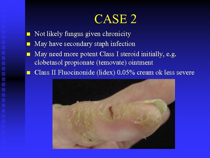 CASE 2 n n Not likely fungus given chronicity May have secondary staph infection