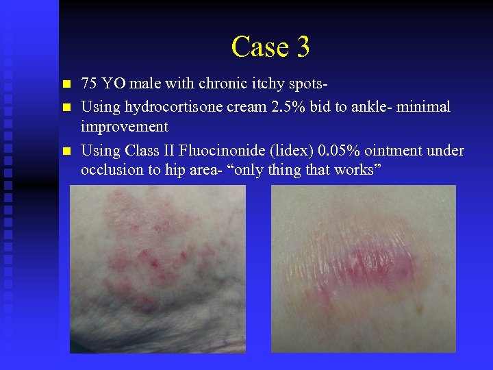 Case 3 n n n 75 YO male with chronic itchy spots. Using hydrocortisone