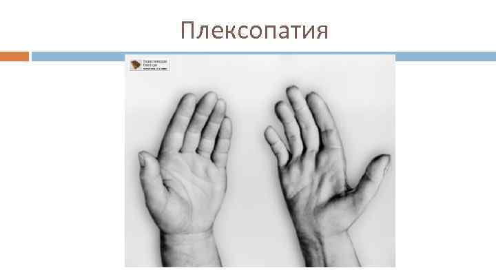 Плексопатия 