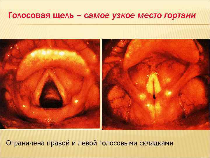 Голосовая щель – самое узкое место гортани Ограничена правой и левой голосовыми складками 