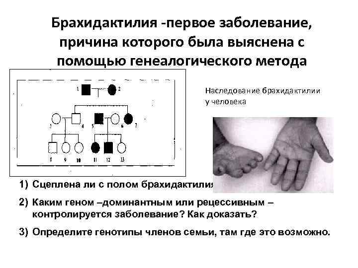 Брахидактилия -первое заболевание, причина которого была выяснена с помощью генеалогического метода Наследование брахидактилии у