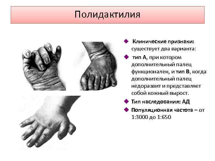 Полидактилия u Клинические признаки: существует два варианта: u тип А, при котором дополнительный палец