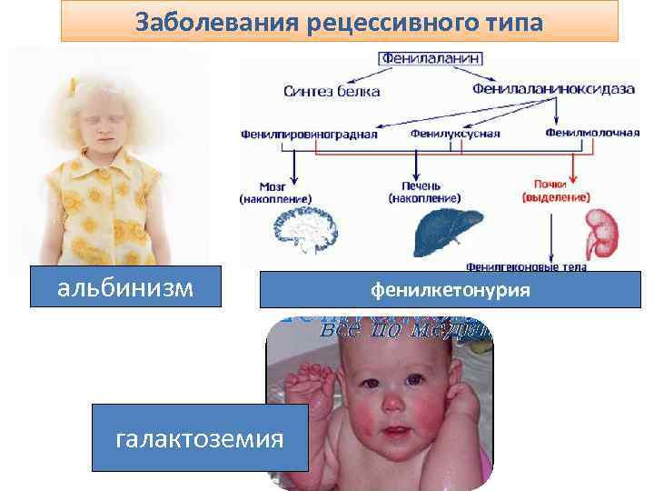 Заболевания рецессивного типа альбинизм галактоземия фенилкетонурия 