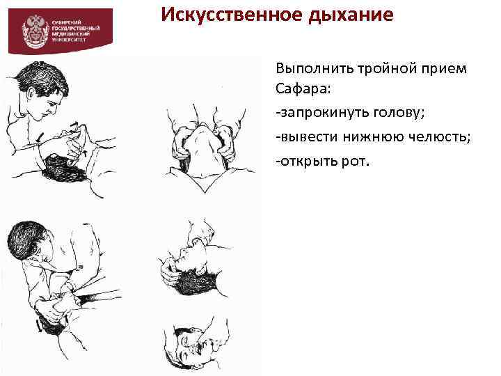 Искусственное дыхание Выполнить тройной прием Сафара: -запрокинуть голову; -вывести нижнюю челюсть; -открыть рот. 