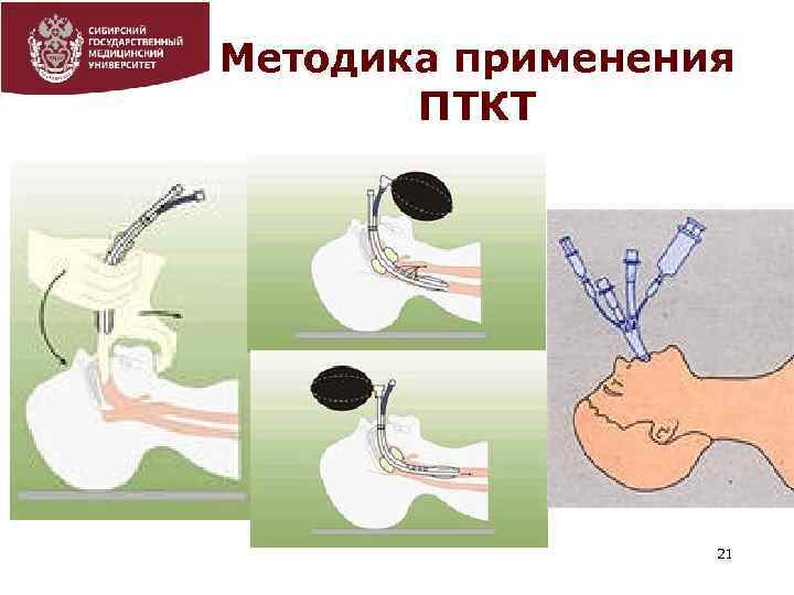 Методика применения ПТКТ 21 