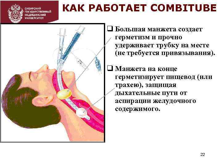 КАК РАБОТАЕТ COMBITUBE q Большая манжета создает герметизм и прочно удерживает трубку на месте