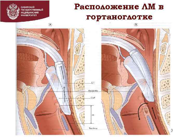Расположение ЛМ в гортаноглотке 40 