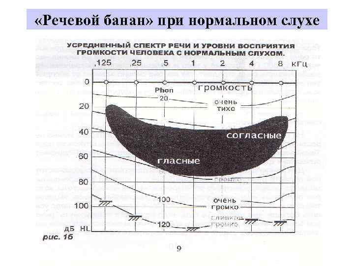  «Речевой банан» при нормальном слухе 