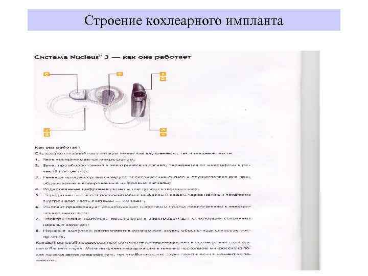 Строение кохлеарного импланта 