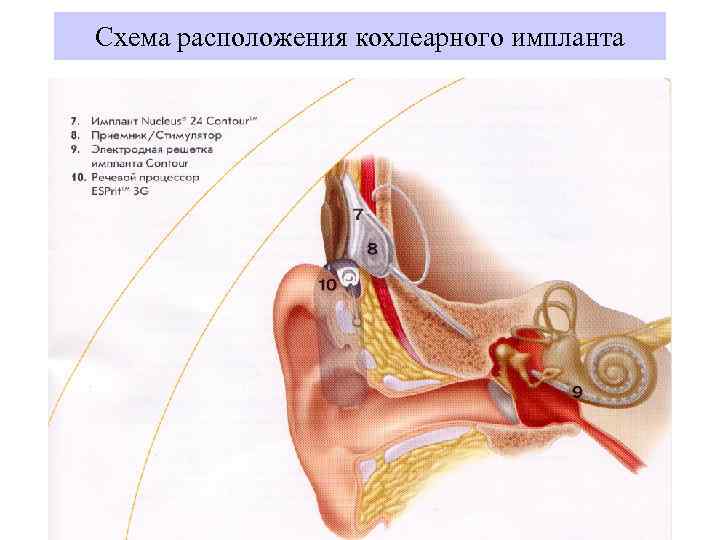 Устройство кохлеарного импланта. Кохлеарная имплантация схема. Кохлеарная имплантация строение уха. Кохлеарный имплантат принцип действия. Строение кохлеарного импланта.