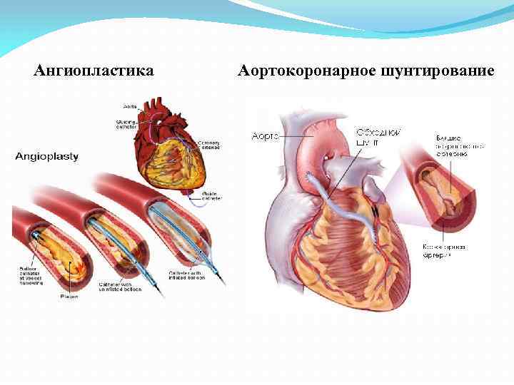 Ангиопластика Аортокоронарное шунтирование 