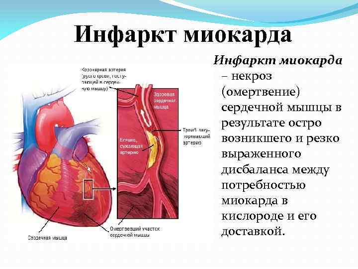 Инфаркт миокарда – некроз (омертвение) сердечной мышцы в результате остро возникшего и резко выраженного