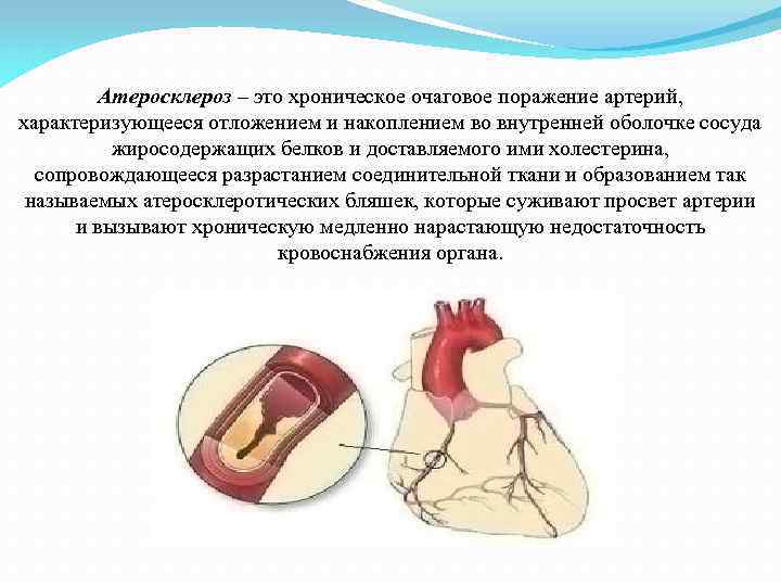 Атеросклероз – это хроническое очаговое поражение артерий, характеризующееся отложением и накоплением во внутренней оболочке