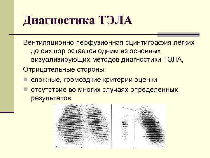 Диагностика ТЭЛА Вентиляционно перфузионная сцинтиграфия легких до сих пор остается одним из основных визуализирующих