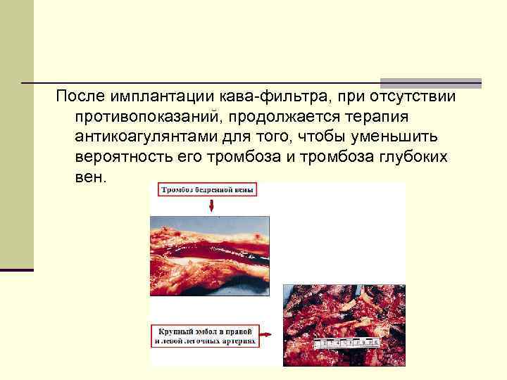 После имплантации кава фильтра, при отсутствии противопоказаний, продолжается терапия антикоагулянтами для того, чтобы уменьшить