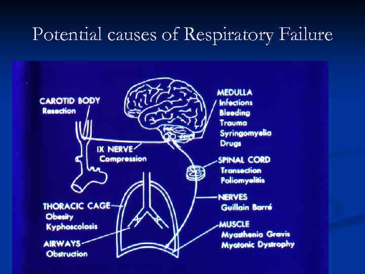 Potential causes of Respiratory Failure 
