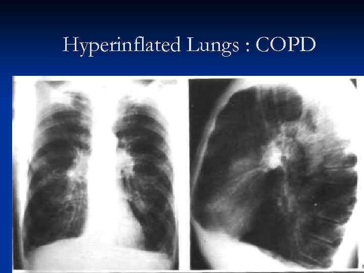 Hyperinflated Lungs : COPD 