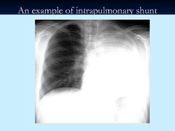 An example of intrapulmonary shunt 